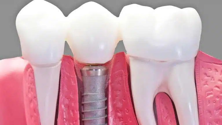 dental implants In Chicago