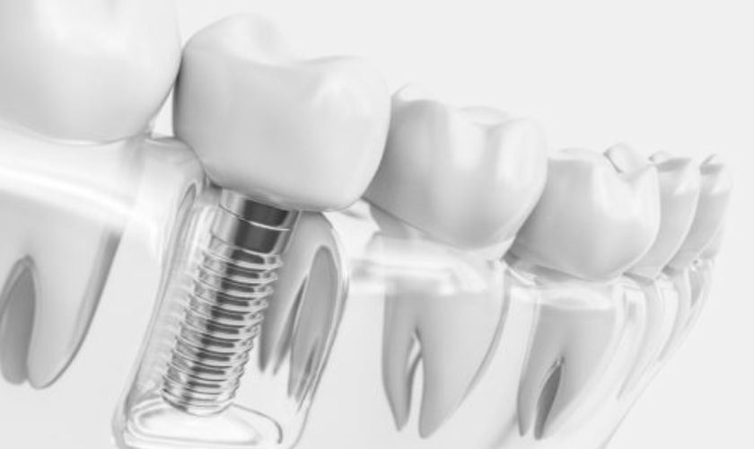 Dental Implants in Chicago, IL
