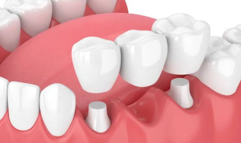 Dental Crowns in Chicago IL