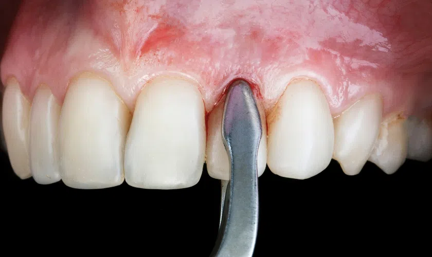 How Long After Tooth Extraction Can Implant Be Done?