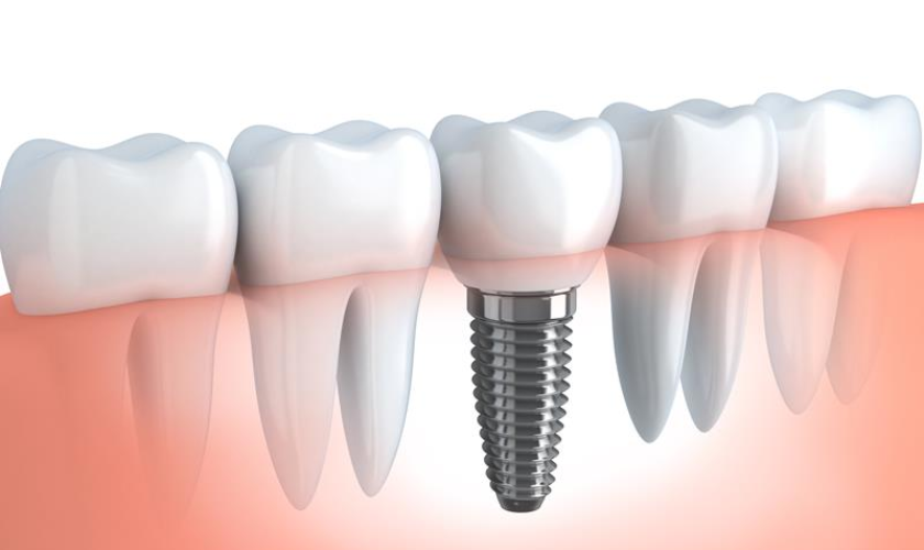Can You Eat Any Foods With Dental Implants
