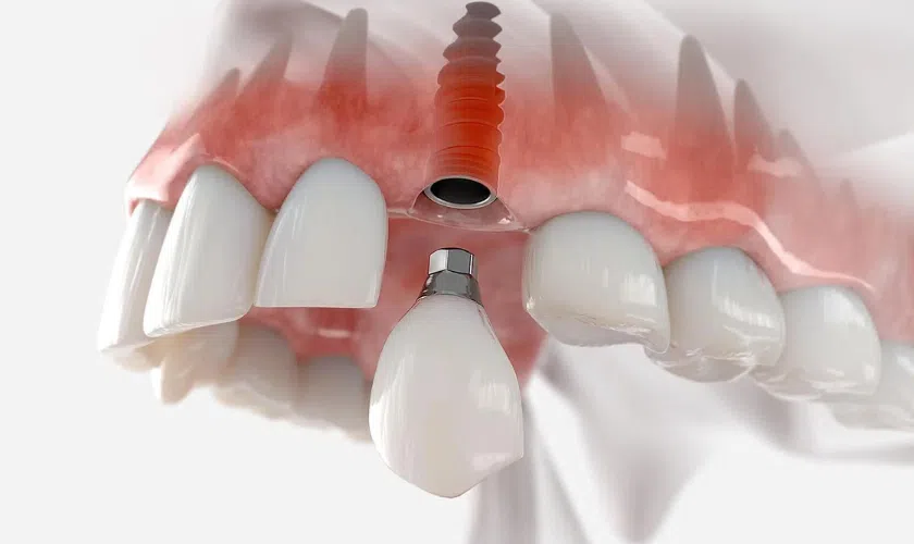 Dental Implants Break
