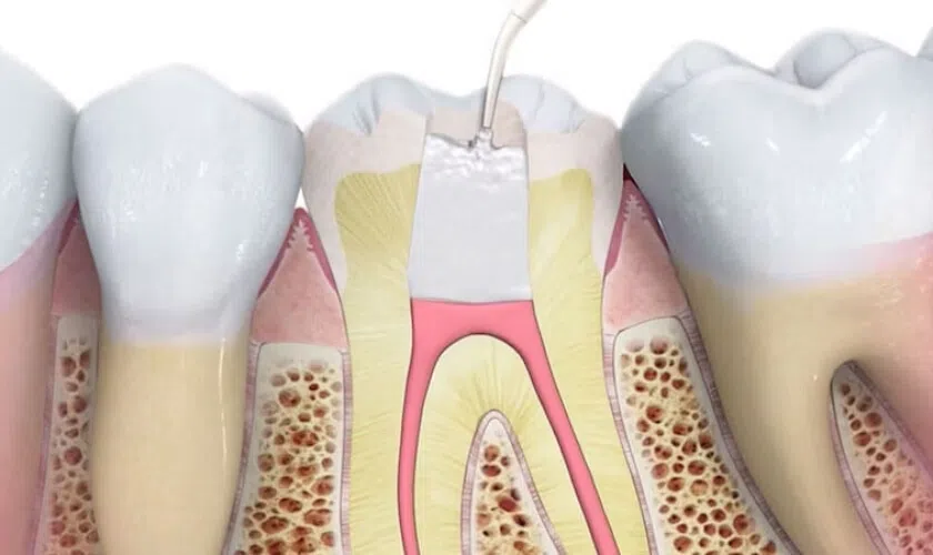What to Do If a Root Canal Gets Infected