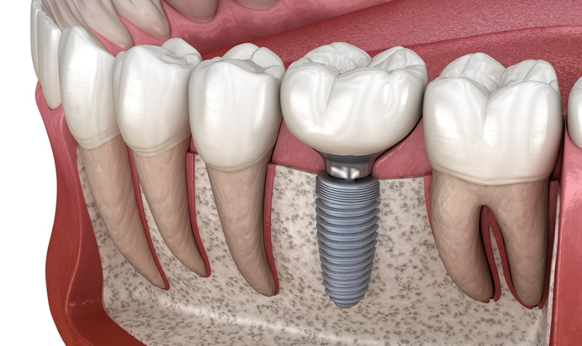 How Should I Maintain My Dental Implants