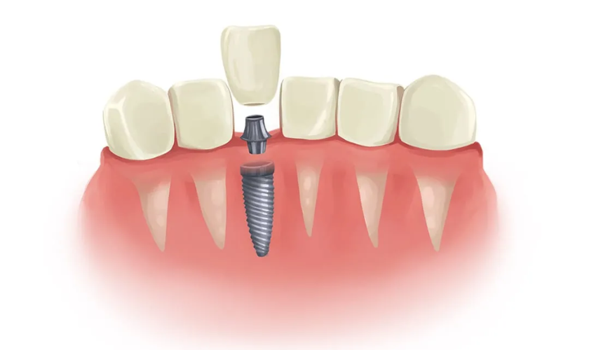 Is Dental Implant for Teeth Good or Bad